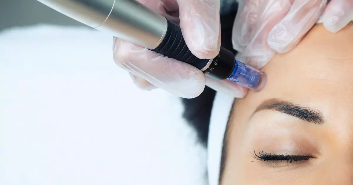 What are The Benefits of Microneedling