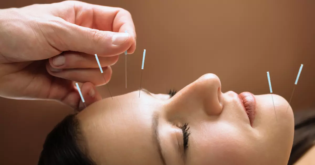 Common Myths and Truths About Facial Acupuncture