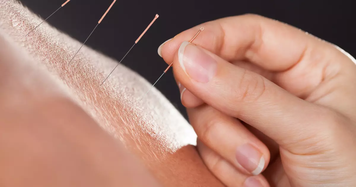 How Does Acupuncture Therapy Align with Modern Medicine