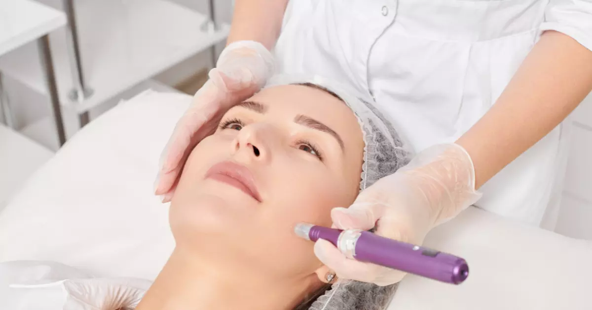 What Are The Common Side Effects of Microneedling