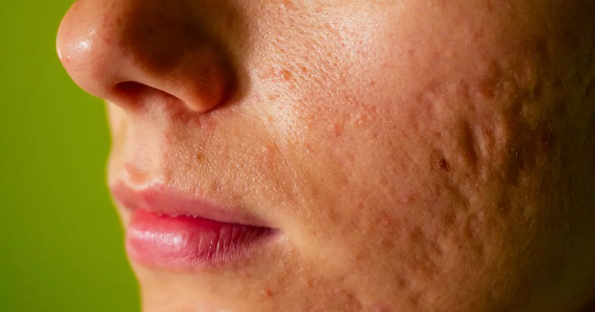 Atrophic Acne Scars