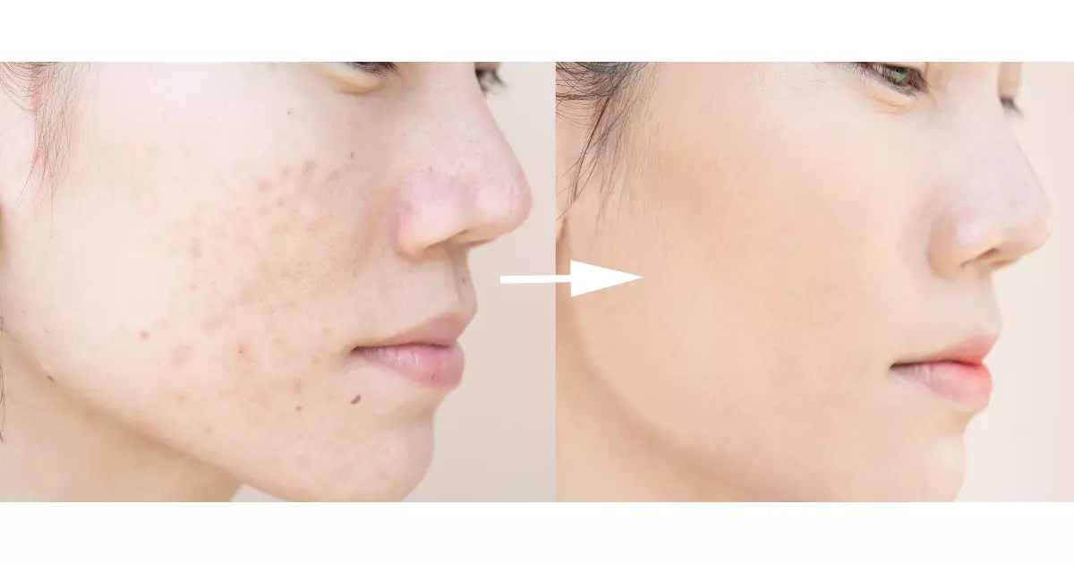 Microneedling for Acne Scars Before and After