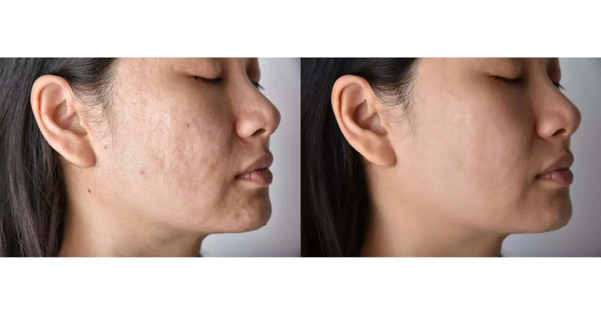 Before and After Microneedling for Acne Scars 