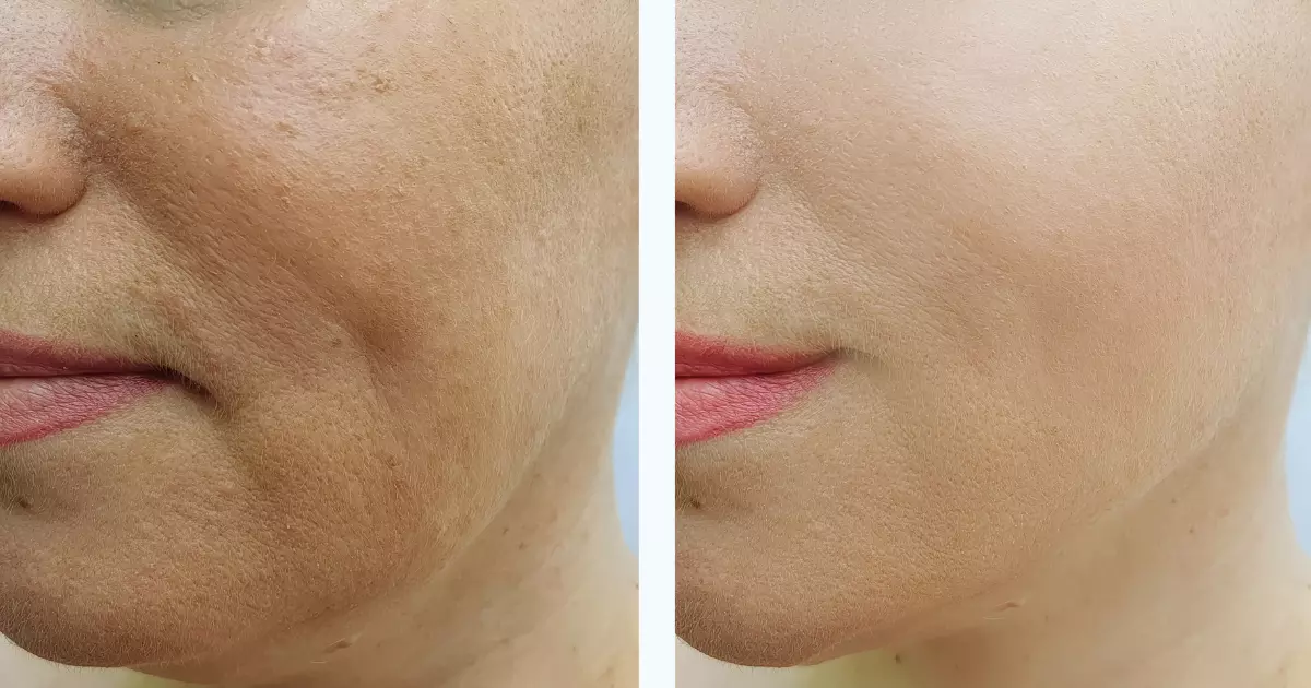 Microneedling for Wrinkles Before and After
