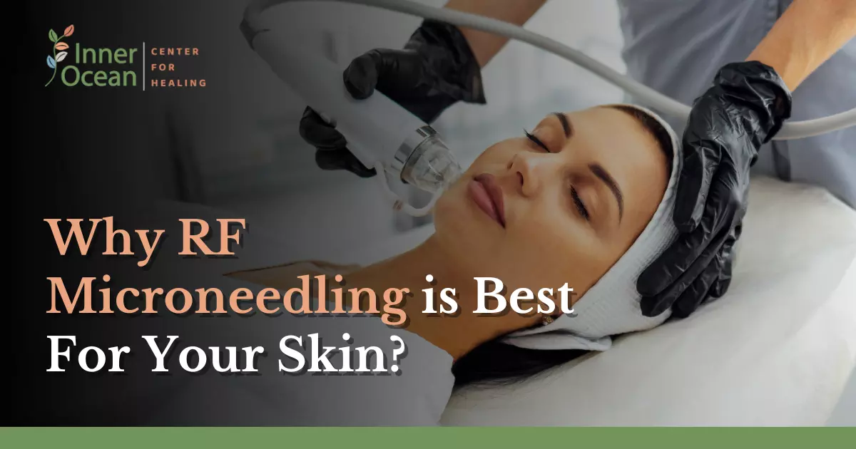 Why RF Microneedling is Best For Your Skin