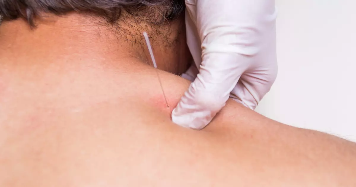 Dry needling