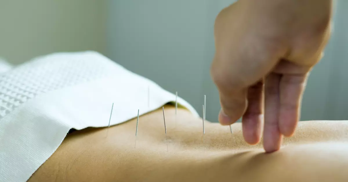 What Are The Benefits of Acupuncture for Sciatica