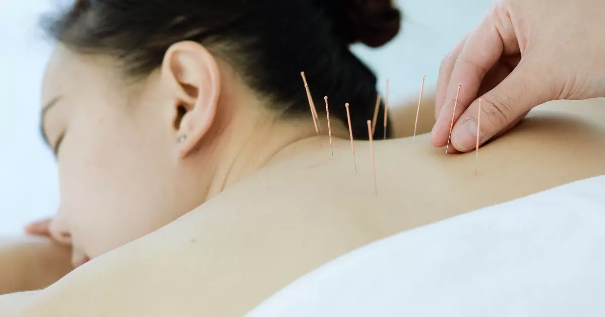 What is Acupuncture
