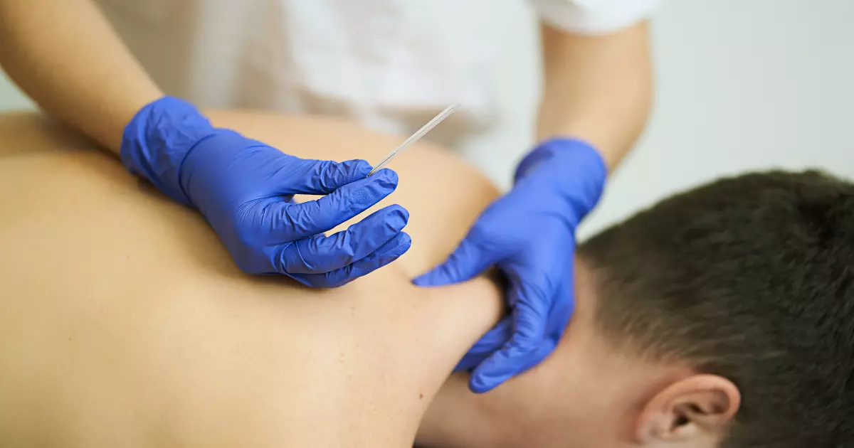 What is Dry Needling