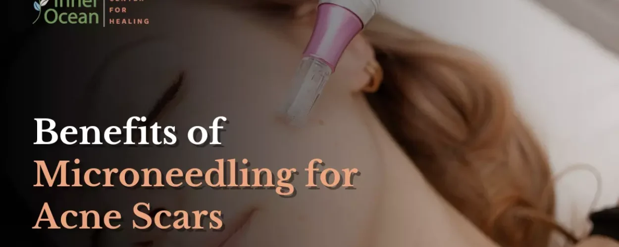 Benefits of Microneedling for Acne Scars