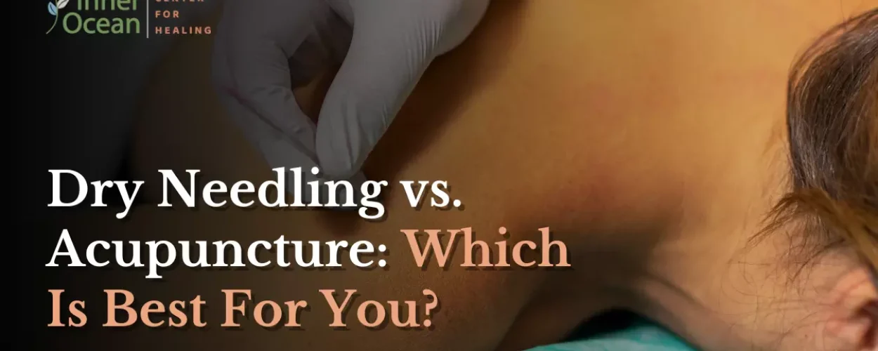 Dry Needling vs. Acupuncture Which Is Best For You