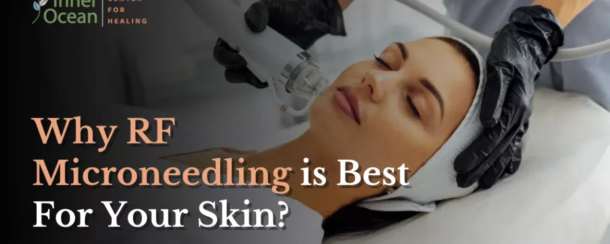 Why RF Microneedling is Best For Your Skin